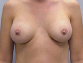 Patient # 75832 After Photo # 2