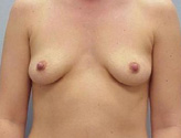 Patient # 75832 Before Photo # 1