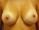 Patient # 71393 After Photo # 2