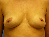 Patient # 71393 Before Photo # 1