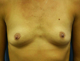Patient # 32714 Before Photo # 1