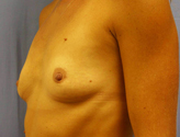 Patient # 32714 Before Photo # 3