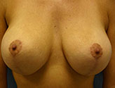 Patient # 16152 After Photo # 2