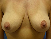 Patient # 16152 Before Photo # 1