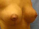 Patient # 57533 After Photo # 4