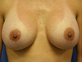 Patient # 90853 After Photo # 2