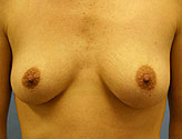 Patient # 90853 Before Photo # 1