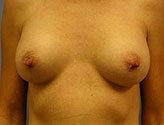 Patient # 94744 After Photo # 2