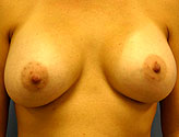 Patient # 98087 After Photo # 2