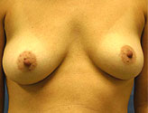 Patient # 98087 Before Photo # 1