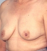 Patient # 39570 After Photo # 4
