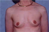 Patient # 51462 Before Photo # 1