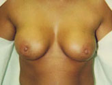 Patient # 35523 After Photo # 2