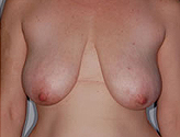 Patient # 12959 Before Photo # 1
