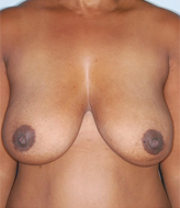Patient # 76780 After Photo # 2