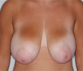 Patient # 54364 Before Photo # 1