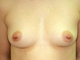 Patient # 40808 Before Photo # 1