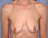 Patient # 43469 Before Photo # 1