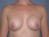 Patient # 64168 After Photo # 2