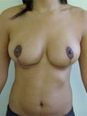 Patient # 87542 After Photo # 2