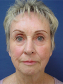 Patient # 36206 Before Photo # 1