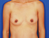 Patient # 88453 Before Photo # 1