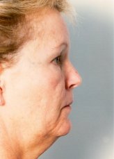 Patient # 37236 Before Photo # 3