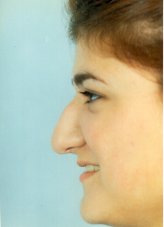 Patient # 55080 Before Photo # 1
