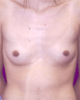 Patient # 11322 Before Photo # 1
