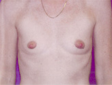 Patient # 21587 Before Photo # 1