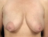 Patient # 24363 Before Photo # 1