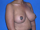 Patient # 54071 After Photo # 6