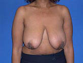 Patient # 54071 Before Photo # 1