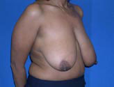 Patient # 54071 Before Photo # 5