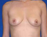 Patient # 99666 Before Photo # 1