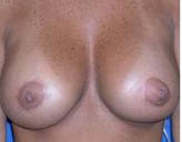 Patient # 10143 After Photo # 2