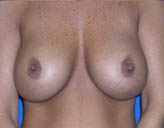 Patient # 10143 Before Photo # 1