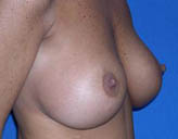 Patient # 10143 Before Photo # 3