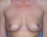 Patient # 93606 After Photo # 2