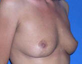 Patient # 93606 After Photo # 4