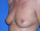 Patient # 93606 After Photo # 6