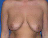 Patient # 93606 Before Photo # 1