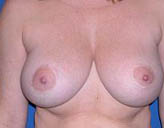 Patient # 83925 After Photo # 2