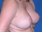 Patient # 83925 After Photo # 4
