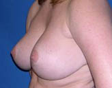 Patient # 83925 After Photo # 6