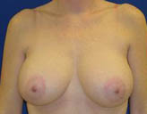 Patient # 13343 After Photo # 2
