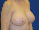 Patient # 13343 After Photo # 4