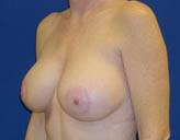 Patient # 13343 After Photo # 6