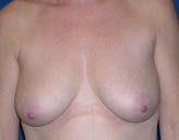 Patient # 13343 Before Photo # 1