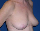 Patient # 13343 Before Photo # 3